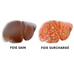 Foie sain - foie surchargé